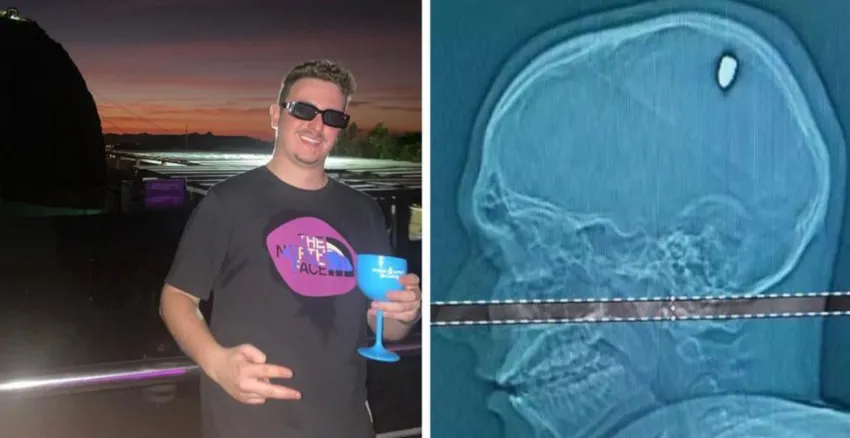 Un joven brasilero estuvo de fiesta por días sin darse cuenta que tenía una bala en la cabeza