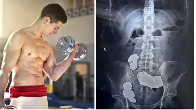 Un fisicoculturista se comió 39 monedas porque pensó que “el zinc lo iba a ayudar” y lo internaron de urgencia