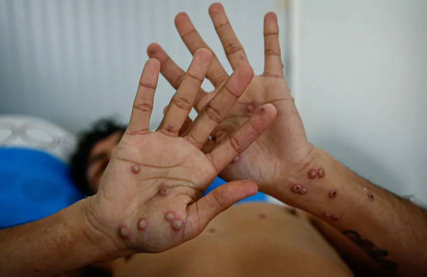 Emergencia global por la viruela del mono: los detalles que ya tiene un caso autóctono en el país