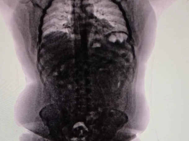 Cayó en Ezeiza un narco que llegaba de Perú y tenía 90 cápsulas de cocaína en el cuerpo